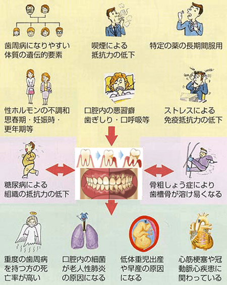 全身と歯周病の関係